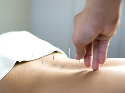 Retrieval IVF acupuncture san diego Retrieval IVF acupuncture san diego